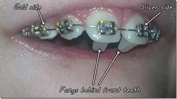 NHL's Braces