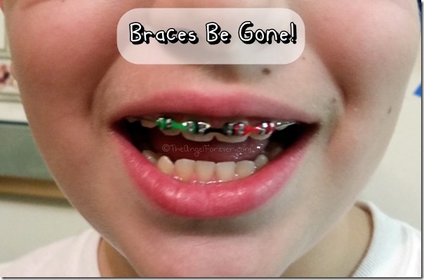 Braces Be Gone